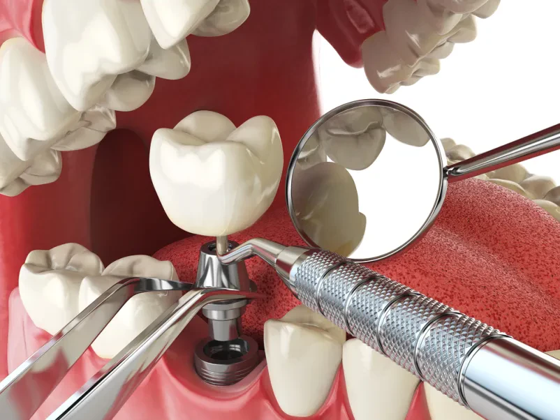Implantati Savinjska