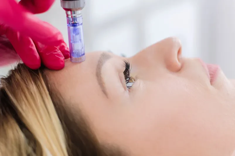 Učinkovit microneedling Ljubljana