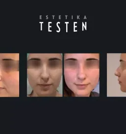 Rinoplastika Slovenija