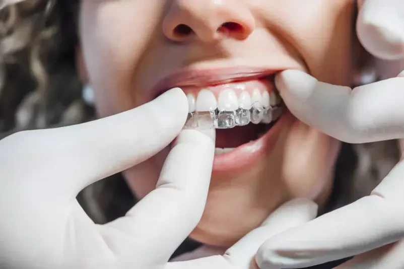 Prozorne zobne opornice Invisalign Novo mesto