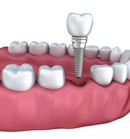 Zobni implantati goriska