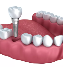 Zobni implantati goriska