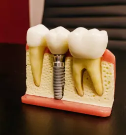 Kvalitetni implantati celje