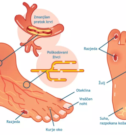 Medicinska pedikura goriska