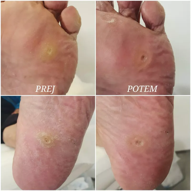 Ugodna medicinska pedikura Pomurje