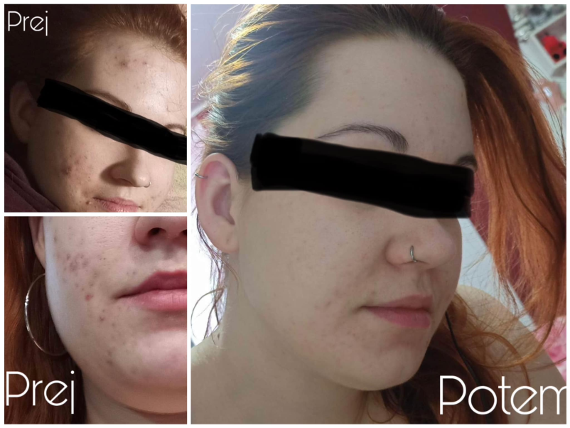 Ugoden microneedling obraza Koroška