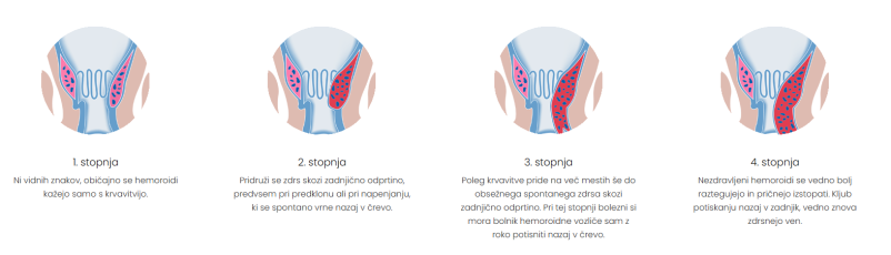 Lasersko zdravljenje hemoroidov Novo mesto