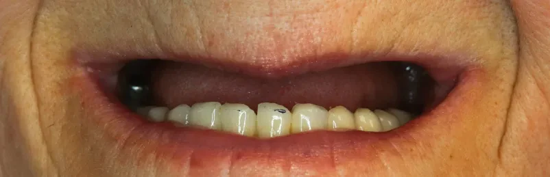Najbolj ugodni zobni implantati Ljubljana Polje