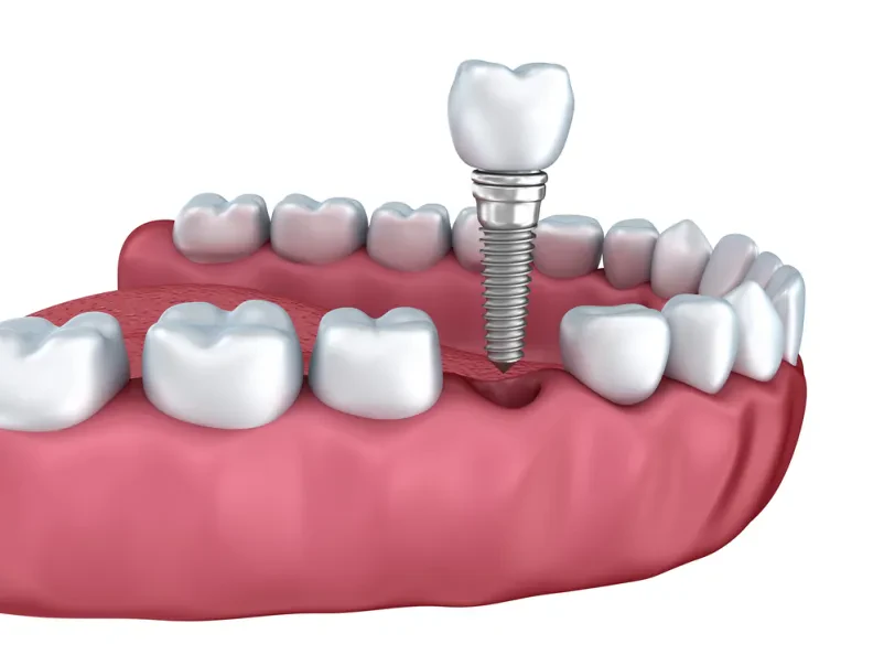 Zobni implantati Osrednja Slovenija