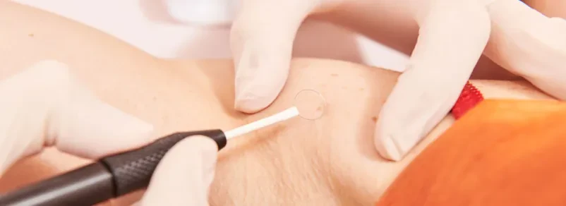 Dermatološki pregled pigmentnih znamenj Nova Gorica