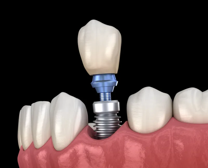 Implantat Kobarid in okolica
