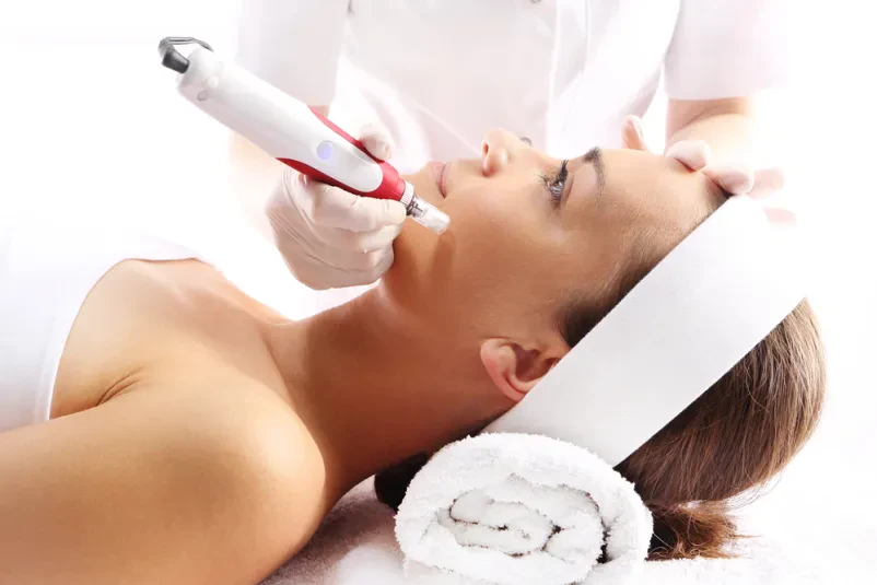 Microneedling - mezoterapija 