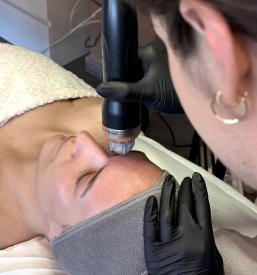 Microneedling