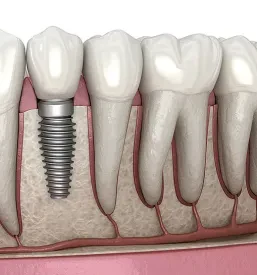 Ugodni implantati Trbovlje