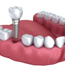 Dentalna implantologija