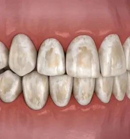 Odstranjevanje dentalnih oblog Primorska