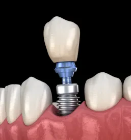Dentalna protetika Osrednja Slovenija
