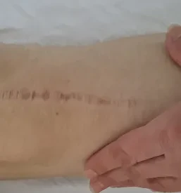 Kvalitetna limfna drenaža Ljubljana